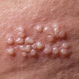 Genital herpes