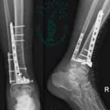 Osteosintezın bütün növləri
