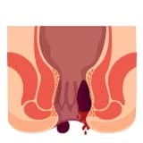 Hemoroid (Babasil) nədir? Hemoroidi necə müalicə etmək olar?