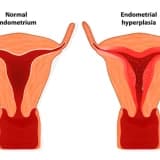 Endometriumun aspirasiya ilə biopsiyası