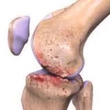 Osteoartrit