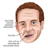 Ramsay Hunt Sindromu nədir? Simptomlar və Müalicə