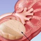 Böyrək şişinin müalicəsi necə olmalıdır?