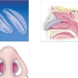 Septum-Concha Cərrahiyyə - Septoplastika