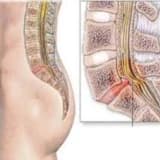 Osteoporoz xesteliyi