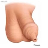 Fimoz (kənar pülüyün daralması)