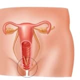 Sidik Kisəsinin Vaginaya Salınması və ya Sidik Kisəsinin Prolapsı (Sistosel)