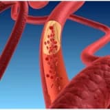 Hiperxolesterolemiya