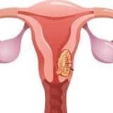 Uşaqlıq boynunun xərçəngi