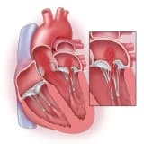 Mitral qapaq əməliyyatı