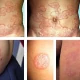 Tinea Corporis (Bədən nahiyyəsinin göbələyi)