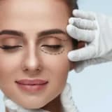 Blefaroplastika - Göz Qapağı Estetikası