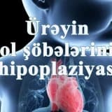 Üreyin sol sobelerinin hipoplaziya sindromu