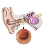 Qulaq Pərdəsi Təmiri