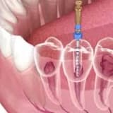 Kök kanalının müalicəsi