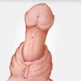 Hipospadiyas