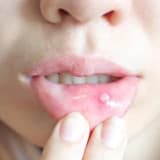Dodaq, dil və ağız boşluğu xəstəlikləri (xərçəng yaraları, herpes və ağızdakı digər xəstəliklər)