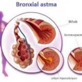 Bronxial astma
