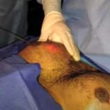 Lazerlə jinekomastiyanın müalicəsi