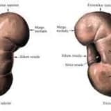 apostematoz pielonefrit