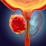 Prostat xərçəngi necə müalicə edilməlidir?