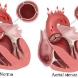 Aorta qapaq əməliyyatları