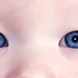 Çəpgözlük (Strabismus) müalicəsi