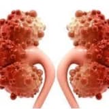 Böyrək kisti nədir? Müalicə edilməlidir?