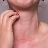 Allergiya