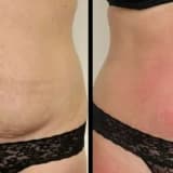 Genişləndirilmiş Abdominoplastika: Bədən Konturlarını Təkmilləşdirməyin İnnovativ Yolu