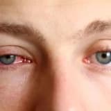 Allergik konjonktivit