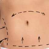 Lipoabdominoplastika