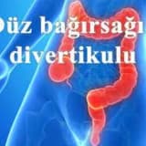Duz bagirsagin divertikulu
