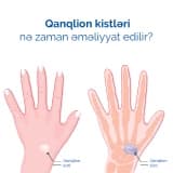 Qanqlion kistləri