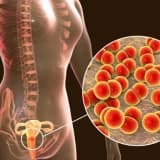 Cinsi yolla keçən infeksiyaların müalicəsi