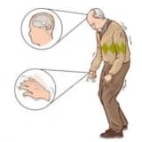 Parkinson xəstəliyi