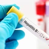 Hepatit: simptomlar, növlər və müalicələr-qaraciyər sağlamlığı üçün nələri bilməlisiniz