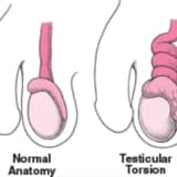 Testis Torsiyası: Ani və Təcili Bir Tibbi Vəziyyət