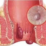 Anal sfinkterin çatismazligi