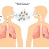 Pleurit: Ağciyər Membranının İltihabı, Səbəbləri, Belirtiləri və Müalicə Üsulları