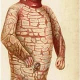 Harlequin Tipli İktiyozis : Nadir Dəri Vəziyyətini Anlamaq