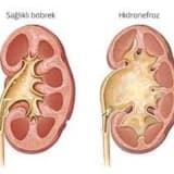 Hidronefroz