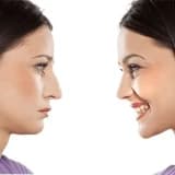 Rinoplastika nədir və necə tətbiq olunur?