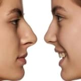 Rinoplastika - Burun Estetik Cərrahiyyəsi