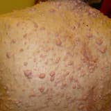 Neyrofibromatoz Tip I: Genetikası, Diaqnozu və Müalicə Yolları