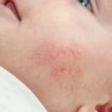 Atopik Dermatit