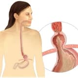 Mədə yırtığı (hiatal yırtıq)