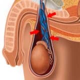 Varikoselin mikrocərrahiyyə yolu ilə müalicəsi