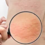 Dərinin allergic xəstəlikləri (Övrə, urikaria)