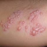 Herpes Zoster (Kəmərləyici Dəmrov)